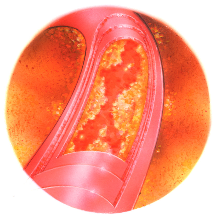 0316 Final Cholesterol